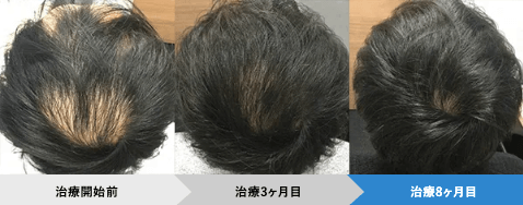 AGAヘアクリニック症例写真