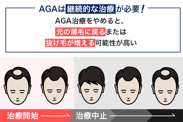 AGA治療をやめた場合の経過