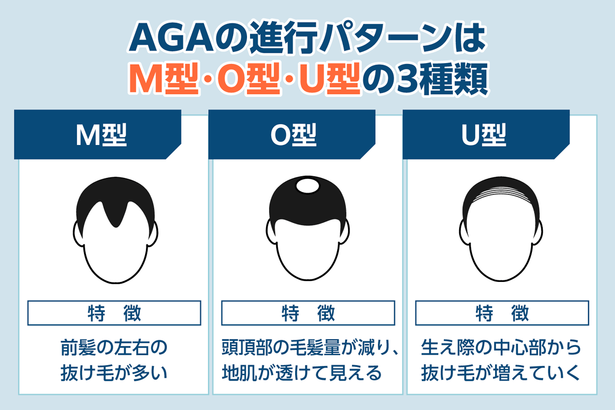 AGAの進行パターンはM型・O型・U型の3種類