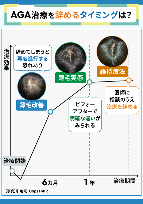 AGA治療を辞めるタイミングに関するグラフ